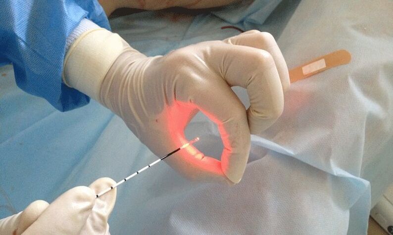 lasersko zdravljenje prostatitisa