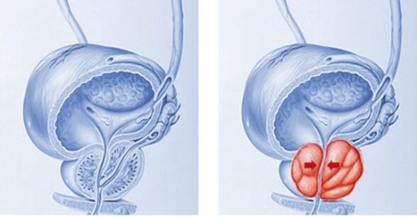 zdrava in vneta prostata s prostatitisom